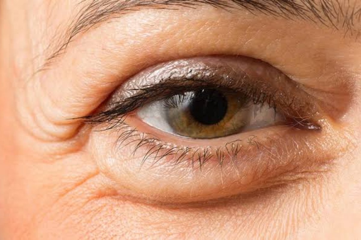 Nem sempre é cansaço: 8 motivos por trás das pálpebras inchadas! 