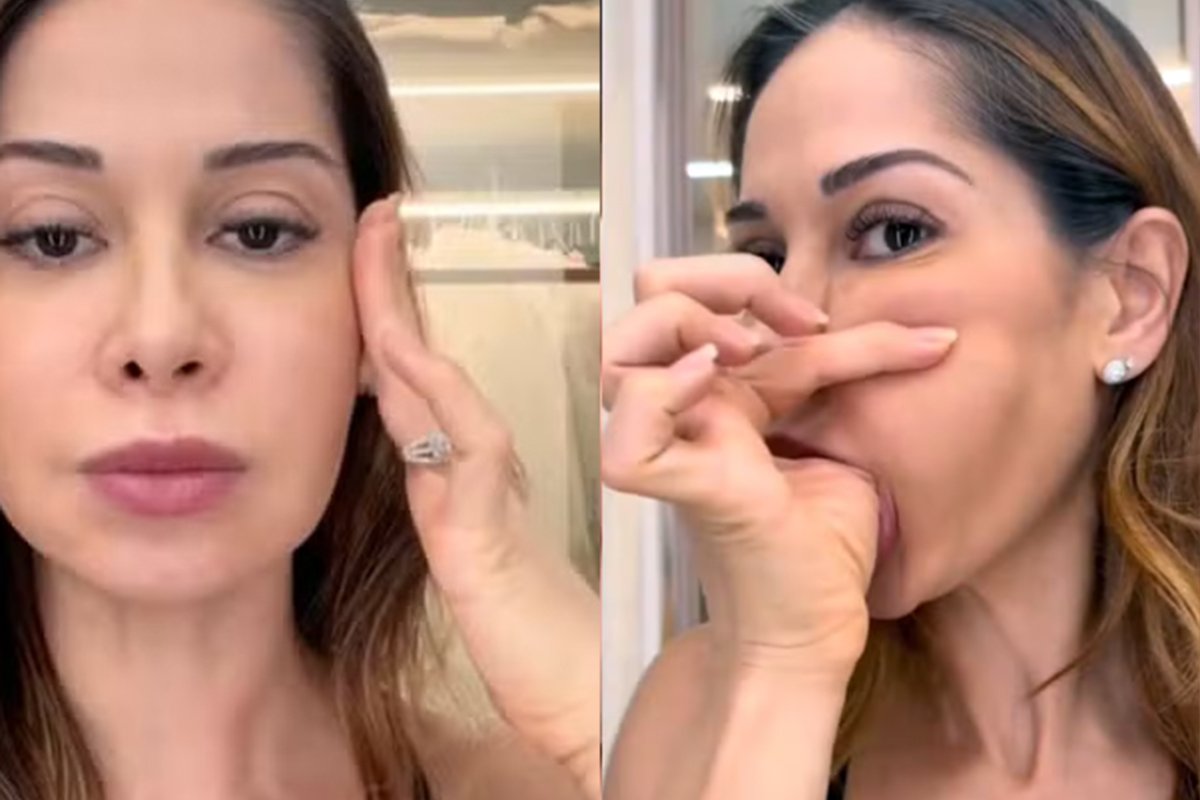 Caso de Maíra Cardi chama atenção para riscos do PMMA em preenchimentos permanentes! 