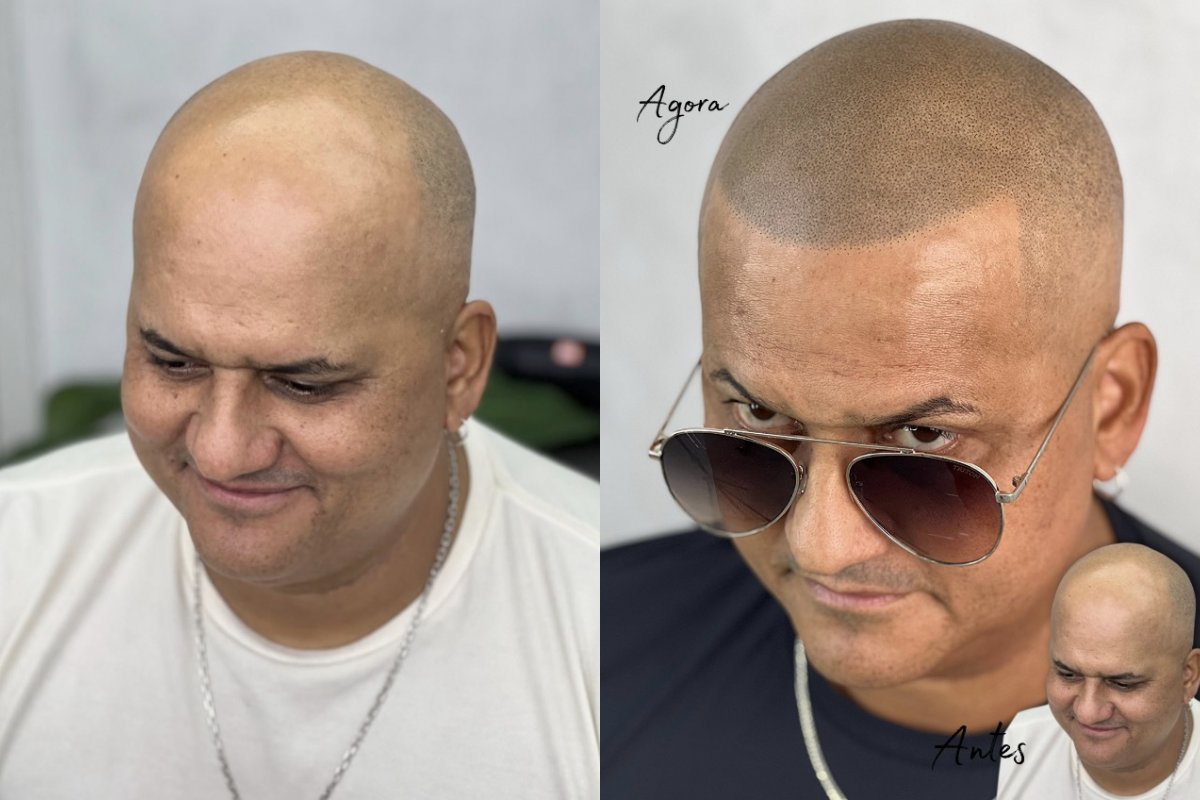 Ceian Muniz avança em tratamento capilar e celebra autoestima após terceira sessão de nanopigmentação! 