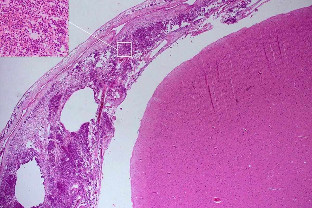 Levantamento aponta que combate mundial à meningite está distante das metas estabelecidas pela OMS; entenda