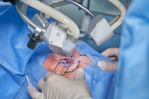 [Sobe para 13 número de pacientes que perderam a visão após cirurgias de catarata ]