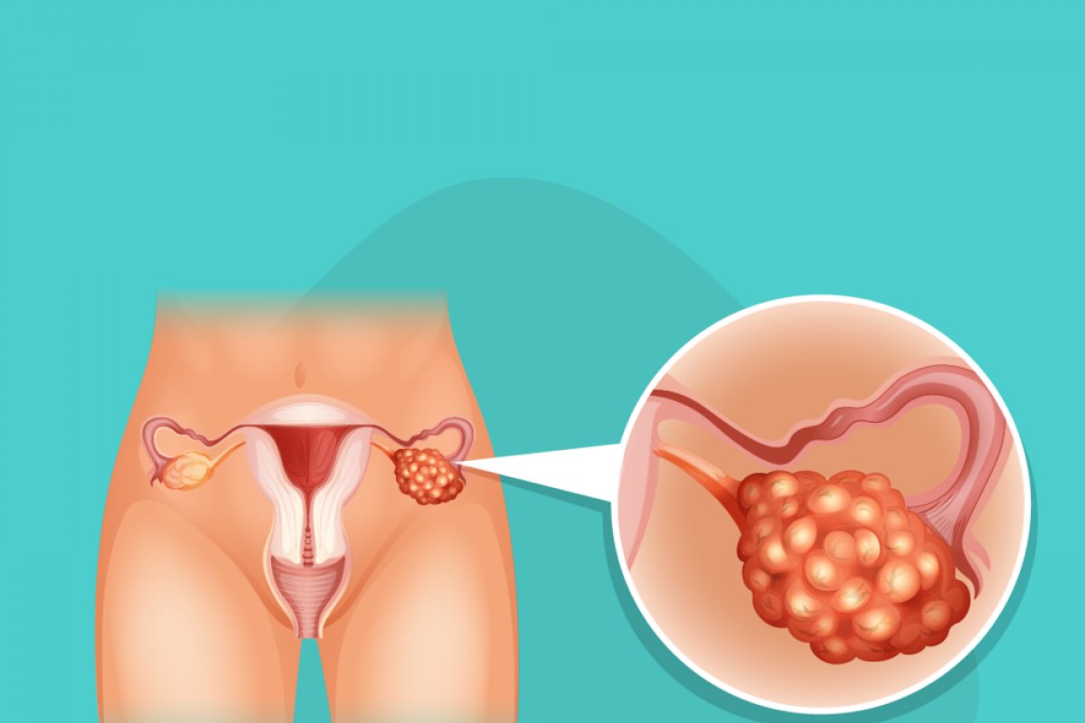 Ovário policístico e miomas ainda cercam milhões de brasileiras de dúvidas! 