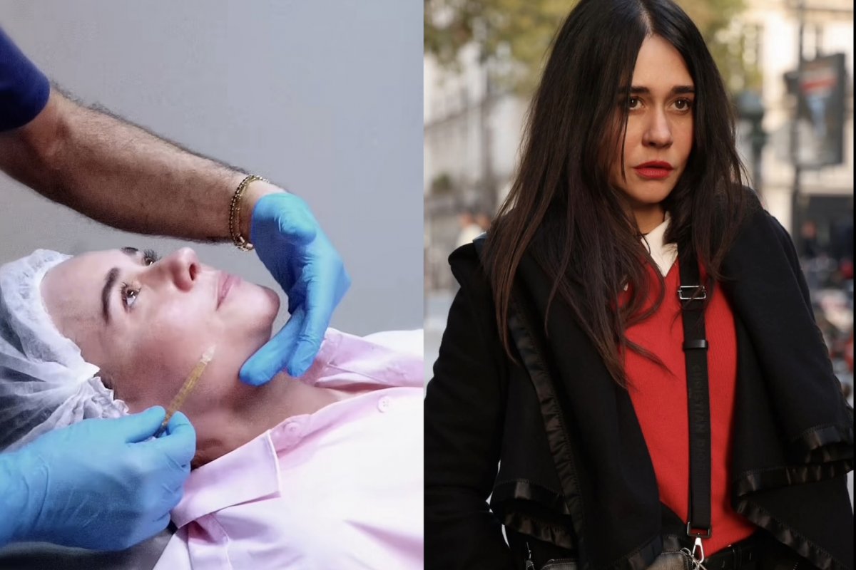 Alessandra Negrini faz tratamento com células-tronco no rosto; especialista explica técnica! 