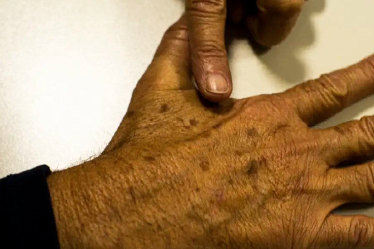 Desinformação sobre câncer de pele afeta diagnóstico, diz instituição