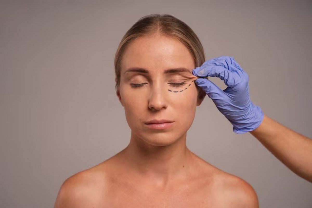Blefaroplastia lidera ranking global e conquista público cada vez mais jovem! 