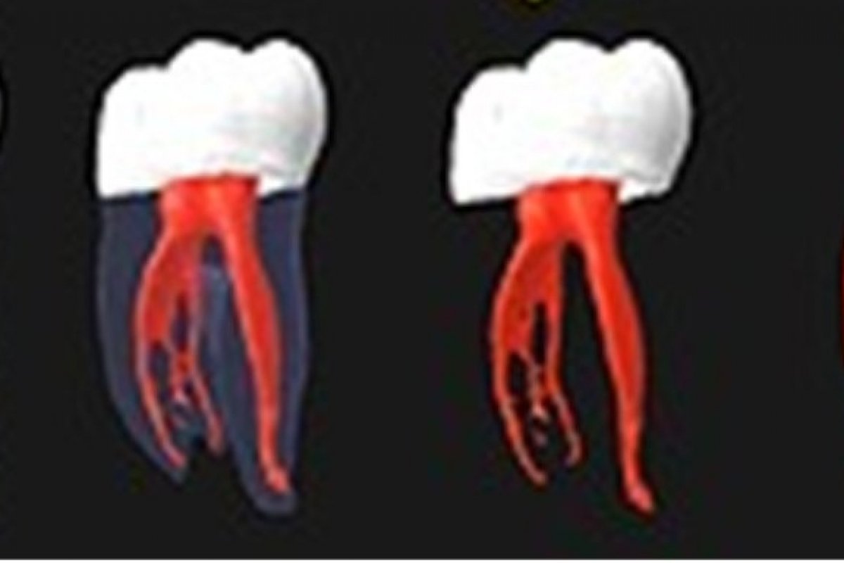 Mitos e verdades: tratamento de canal