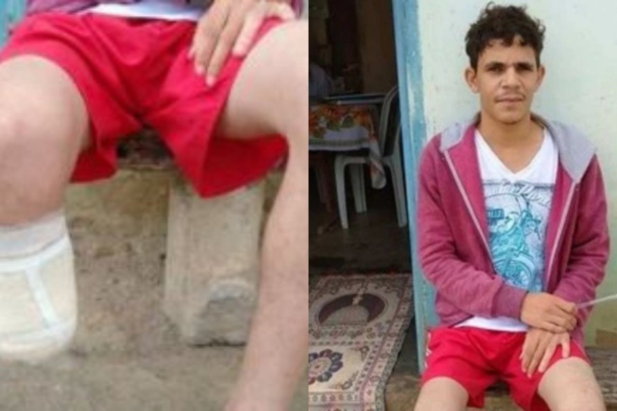 Pé de servidor baiano que amputou o próprio membro para receber indenização milionária foi encontrado dentro de mochila dele