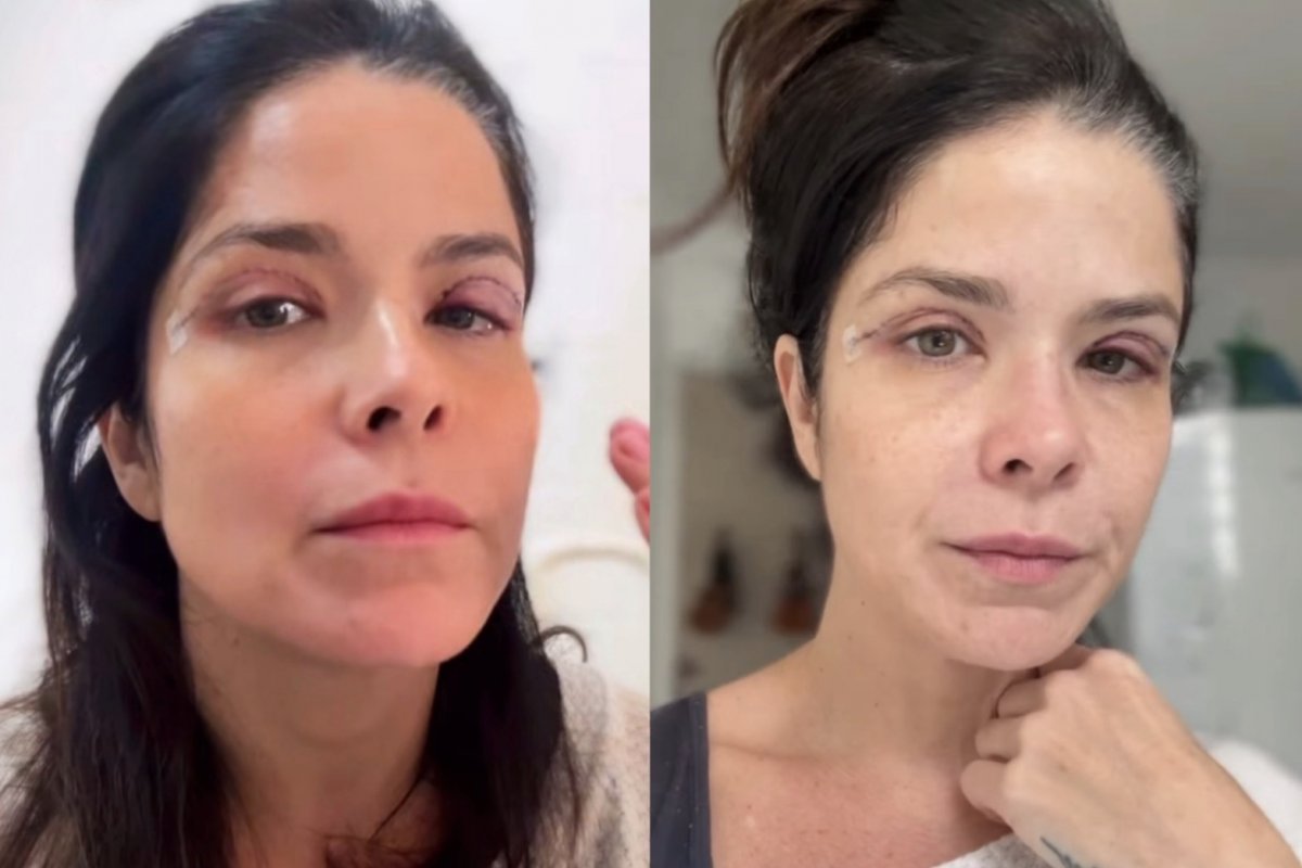 Cirurgia feita por Samara Felippo chama atenção para casos em que o excesso de pele nas pálpebras compromete a visão! 