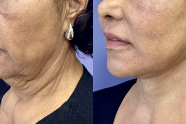 [Cirurgião plástico baiano explica tudo sobre o lifting de pescoço Deep Neck! ]