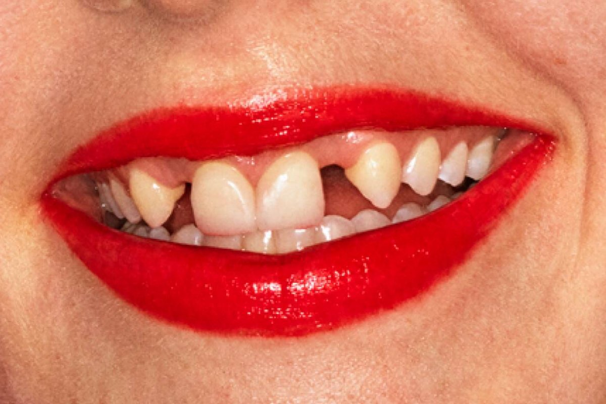 Os dentes imperfeitos são a nova tendência de beleza