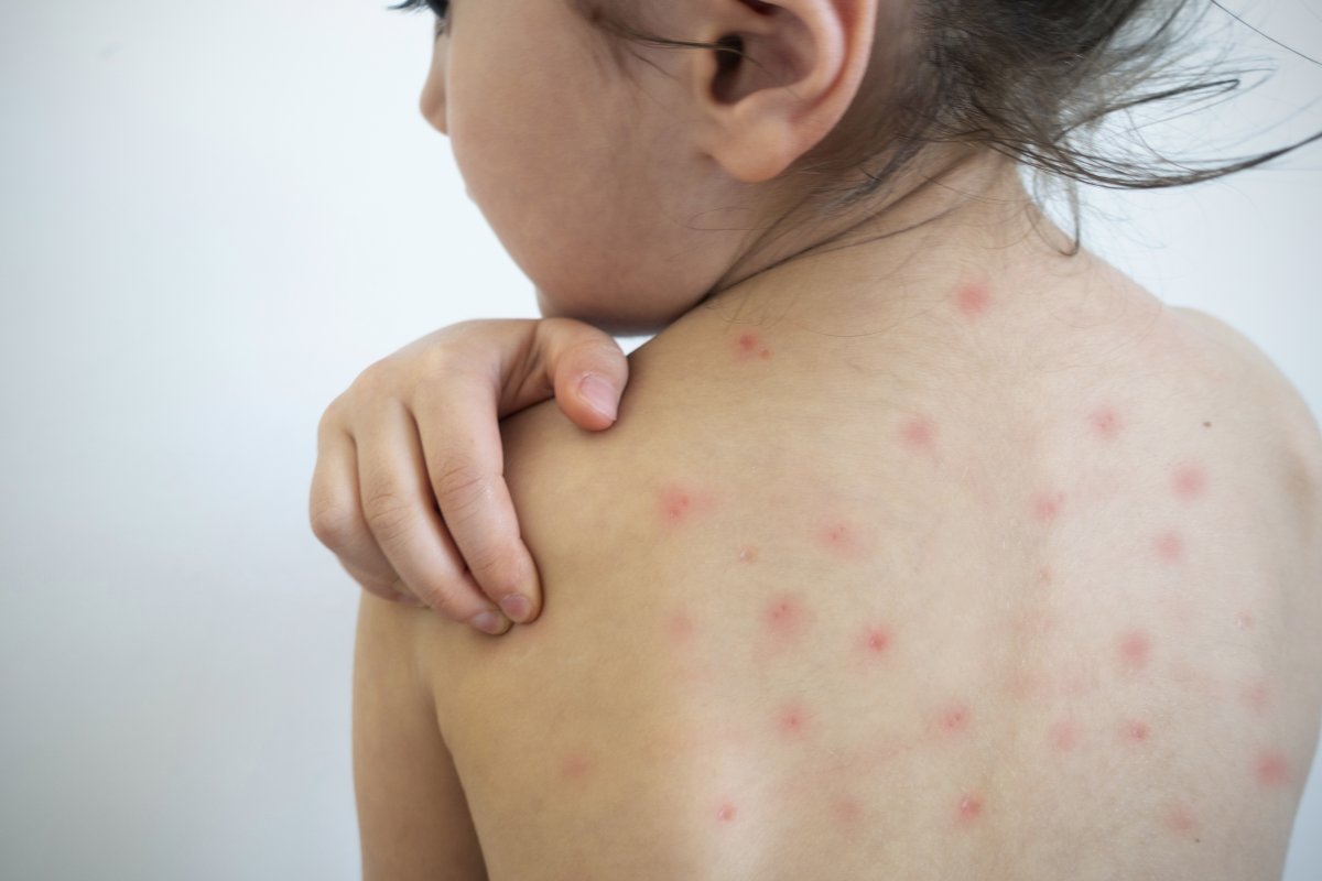 Além do coronavírus, Brasil enfrenta avanço do sarampo