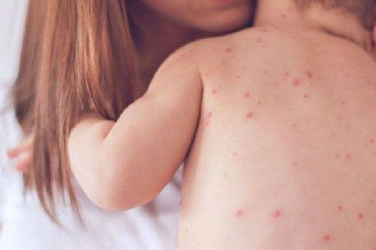 SP tem aumento de 300% nos casos de sarampo