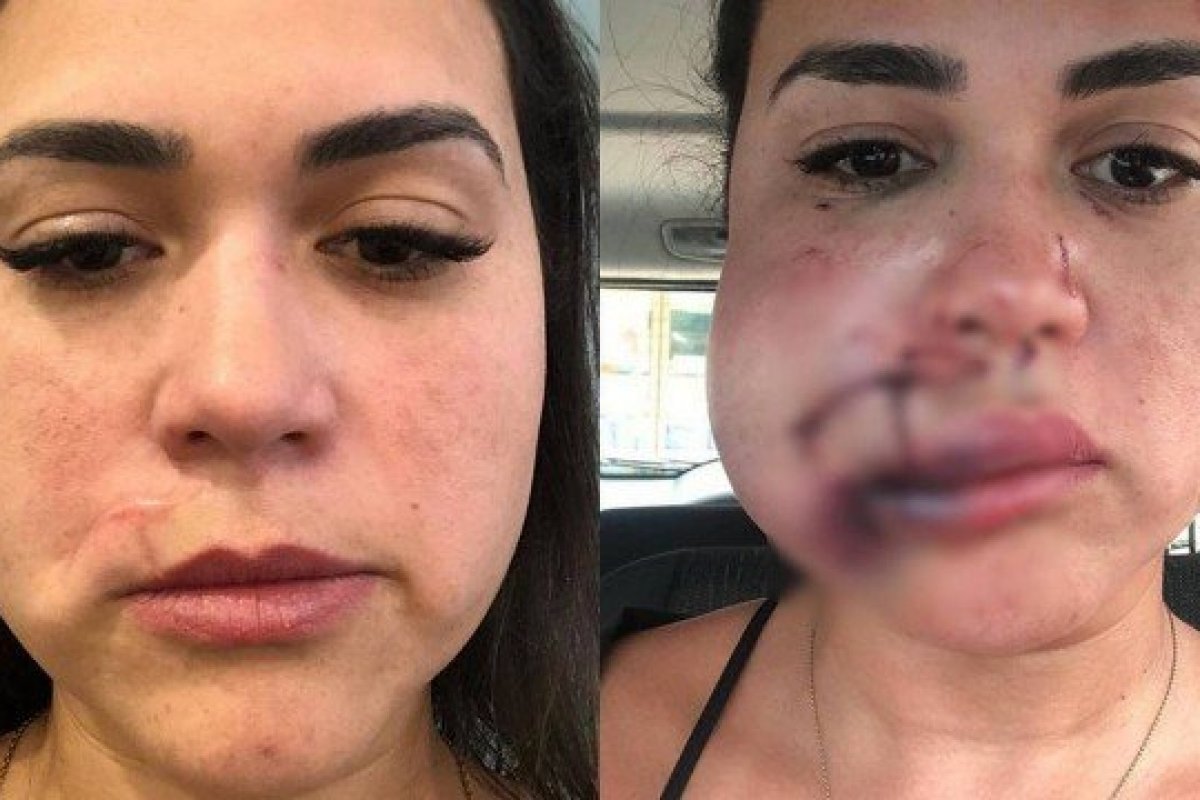 Mulher agredida por modelo em restaurante de luxo de SP mostra reconstrução facial