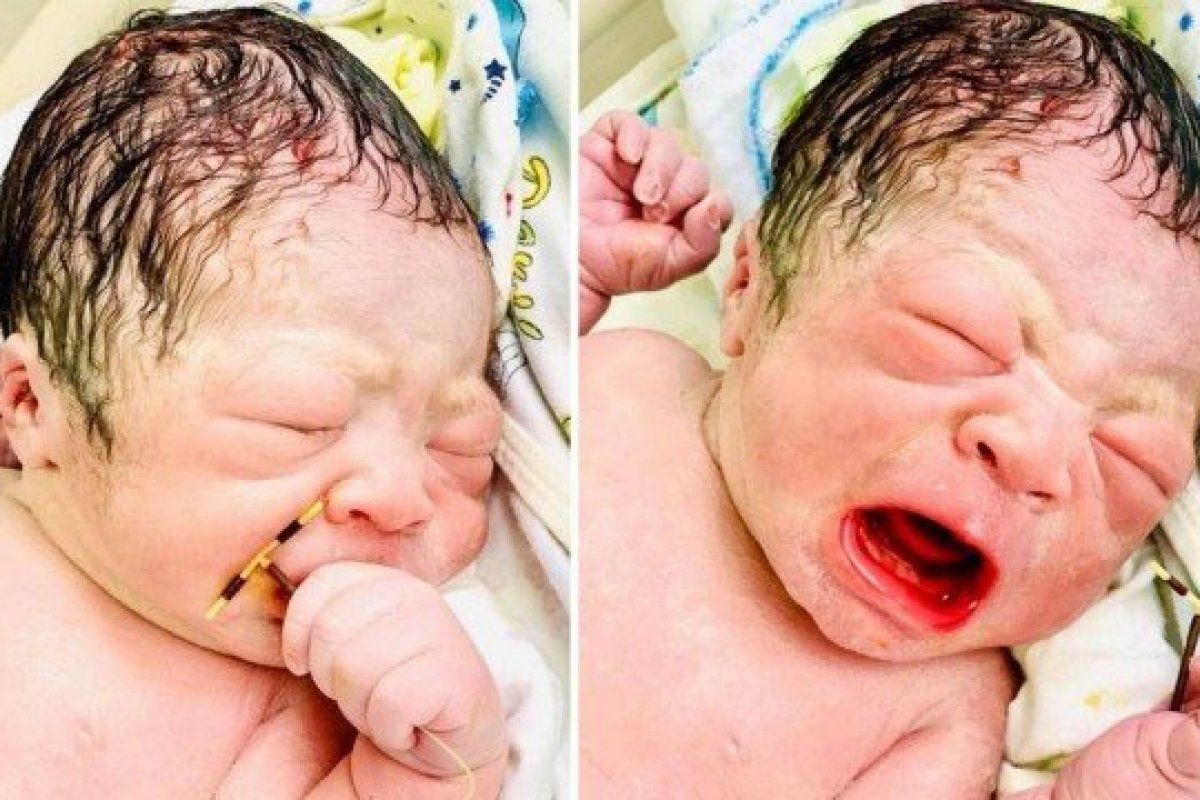 Imagem de bebê viraliza após ele nascer com DIU na mão