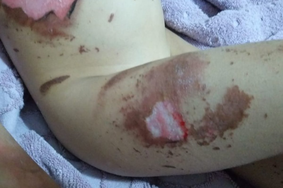Celular explode e causa queimaduras de segundo grau em criança