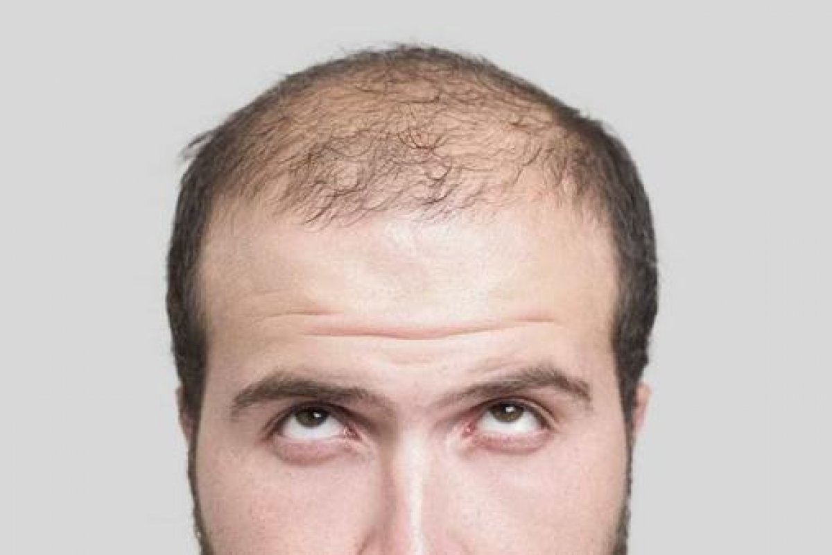 Microinfusão de medicamentos no couro cabeludo inibe queda capilar e auxilia crescimento