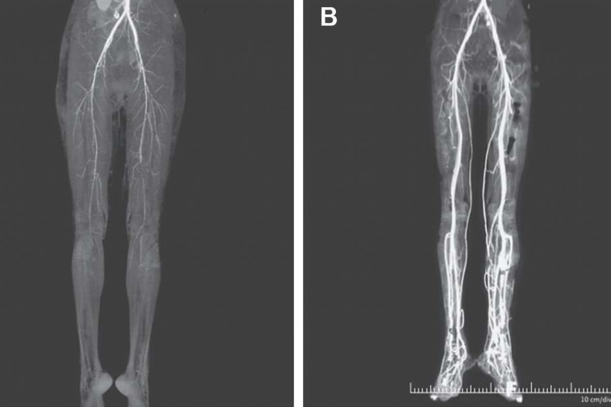 Jovem é diagnosticada com ergotismo, doença comum na Idade Média
