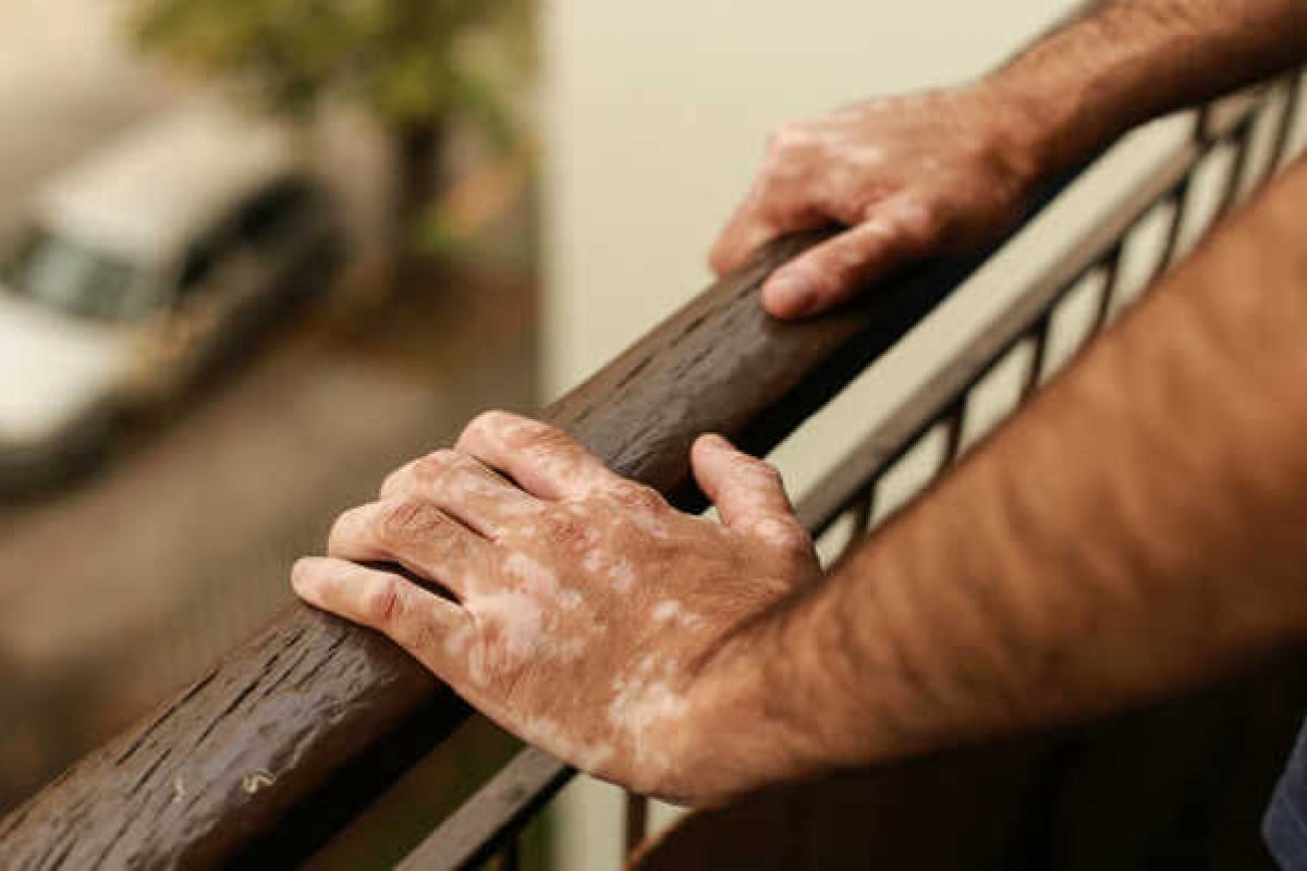 Portadores de vitiligo ainda sofrem preconceito no mercado de trabalho e nas relações cotidianas