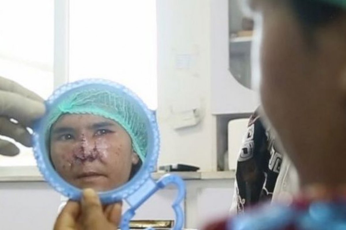 “Ele sacou uma faca e cortou meu nariz”, diz vítima de violência doméstica no Afeganistão