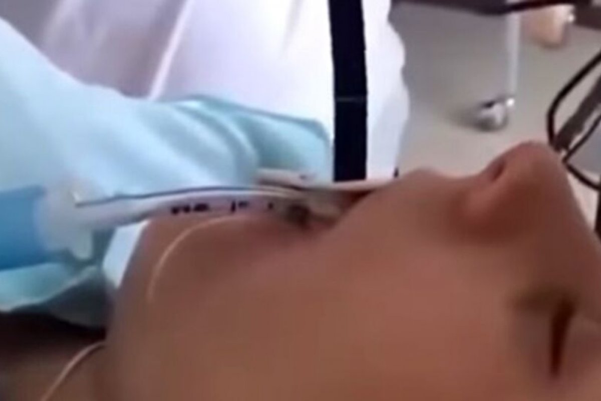 Vídeo: Médicos russos tiram cobra de 1,5 metros da boca de uma mulher