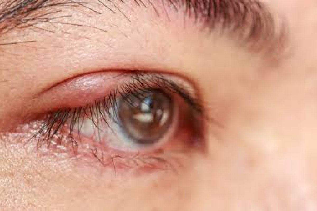 Qual a relação do terçol com a inflamação crônica das pálpebras?