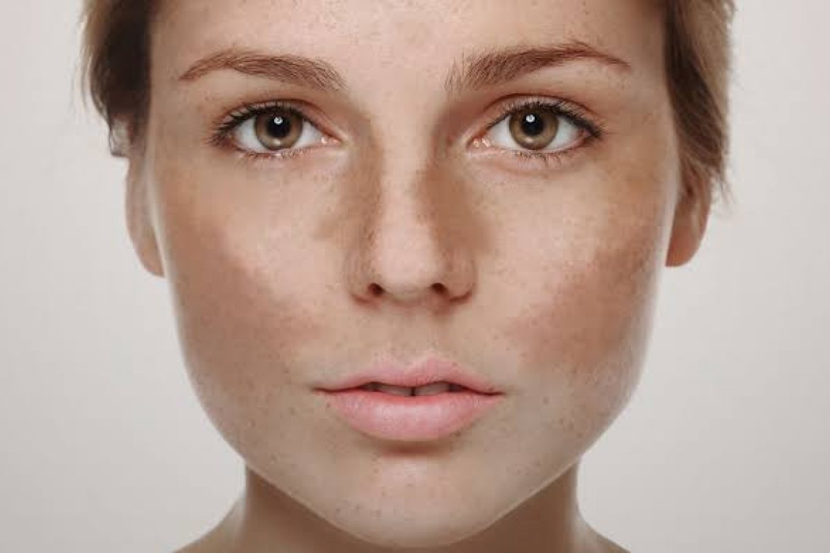 Manchas escuras no rosto? Entenda como minimizar o melasma