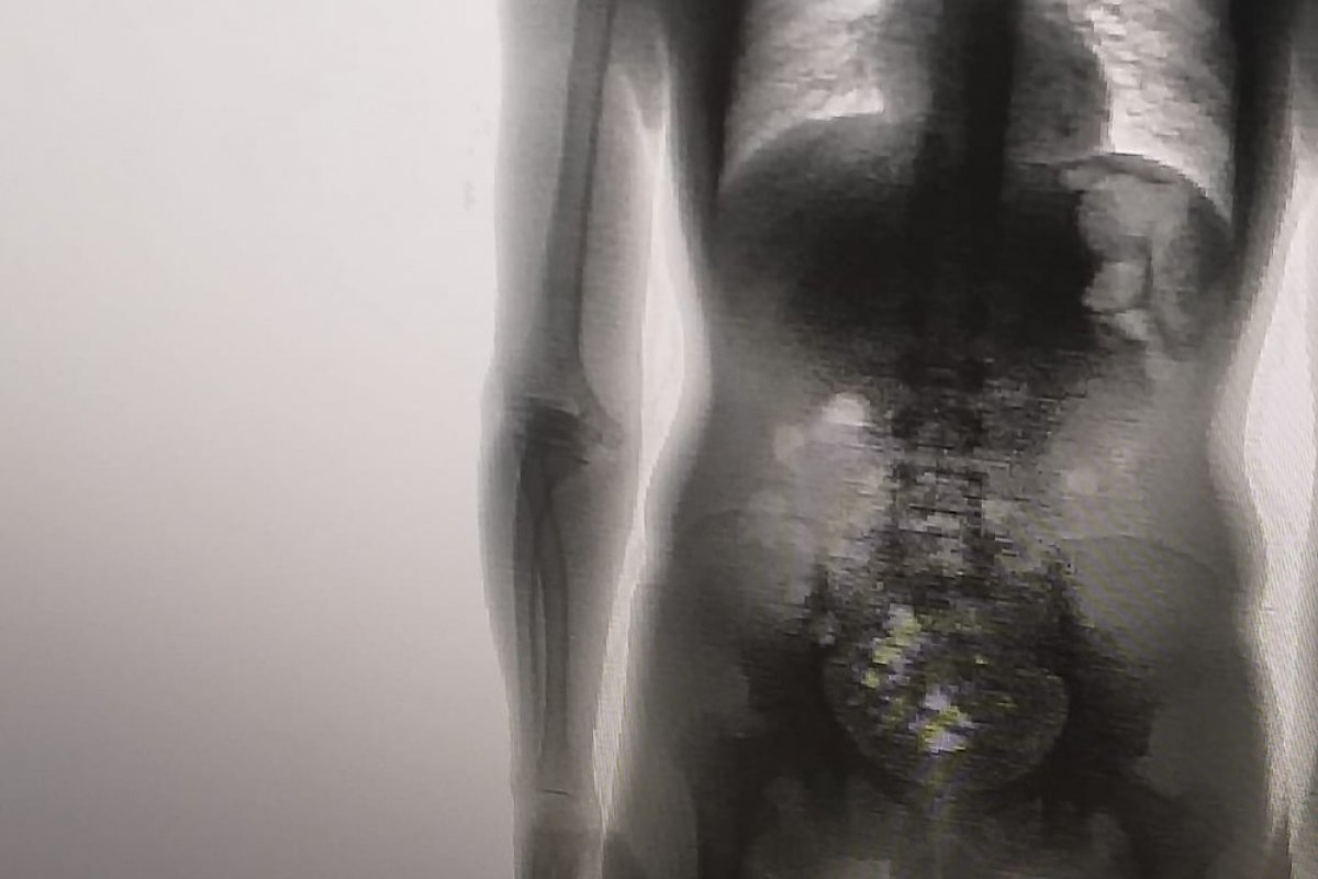 Detento é flagrado com oito celulares dentro do corpo durante revista em um presídio