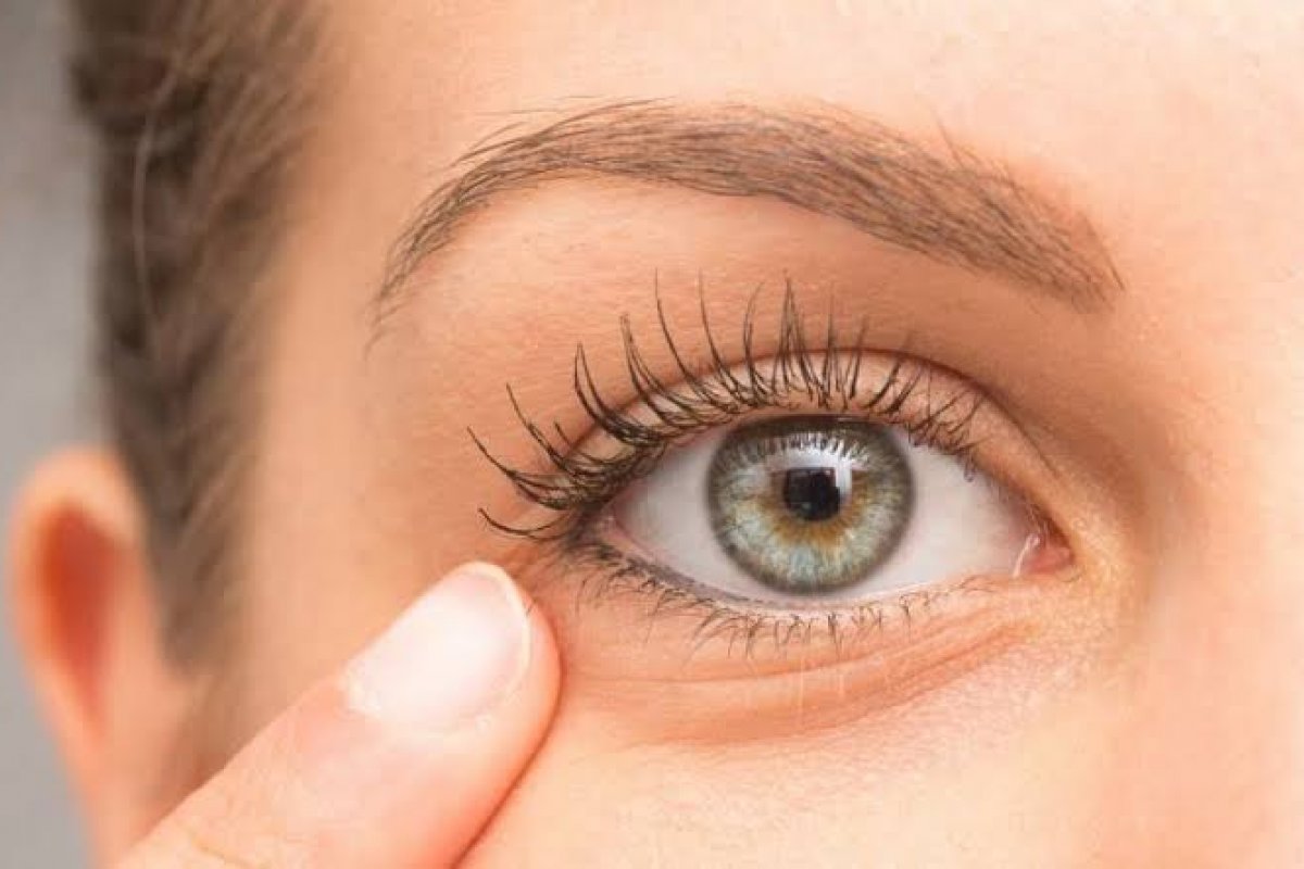 6 motivos e soluções para as olheiras