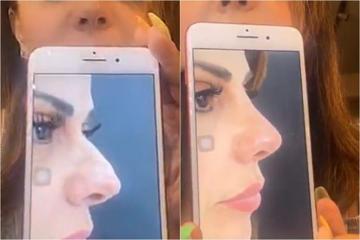 Viviane Araújo passa por rinoplastia e mostra o resultado: “Me incomodava”