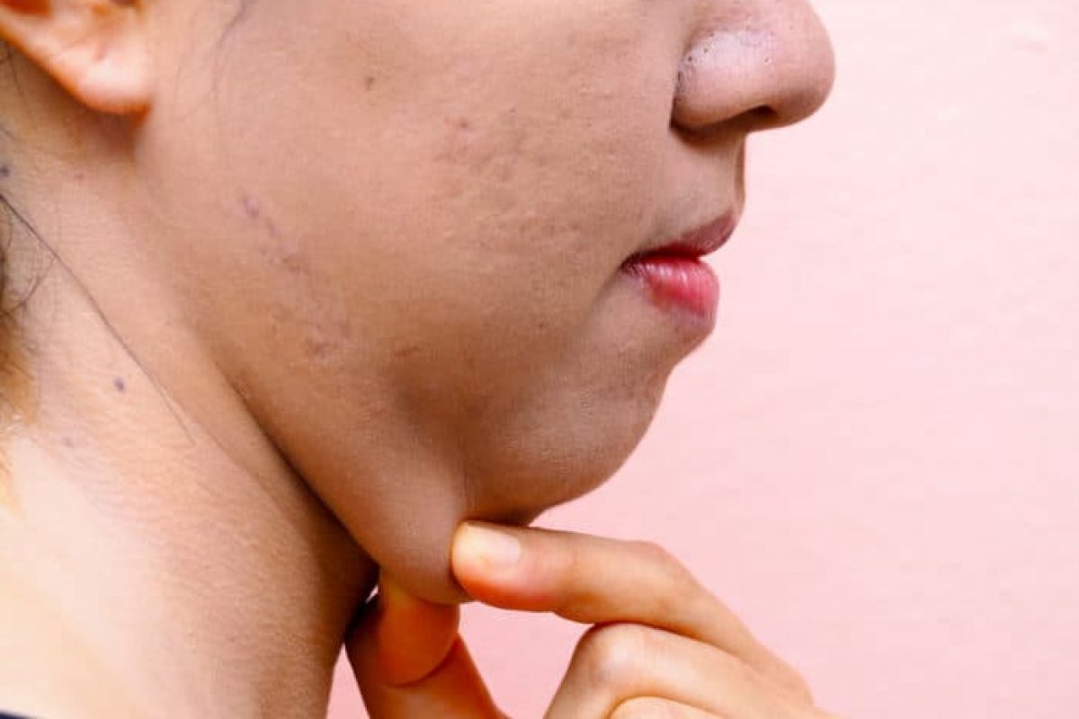 Papada: como tratar?