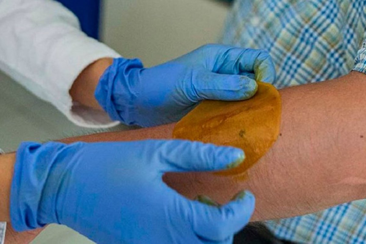 Cientistas criam adesivo de mel que regenera pele de diabéticos em até 21 dias