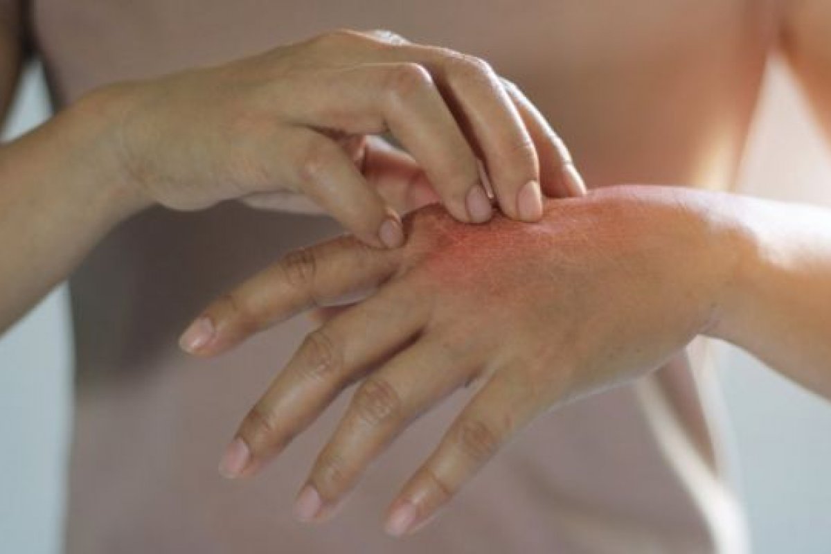 Mutirão virtual oferece consultas gratuitas para diagnóstico e orientação sobre psoríase