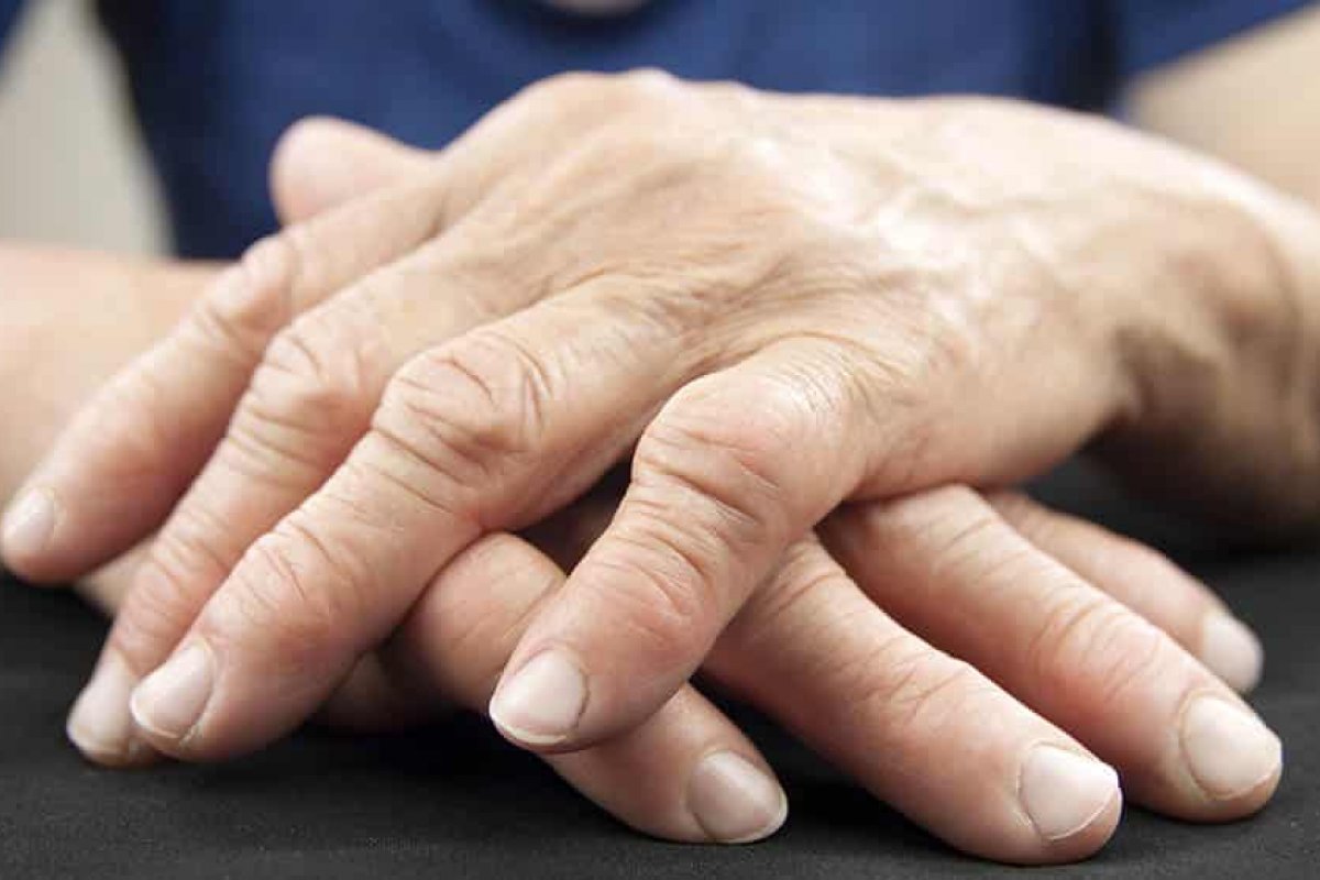 Artrite reumatoide: apenas 47% dos pacientes procuram ajuda médica