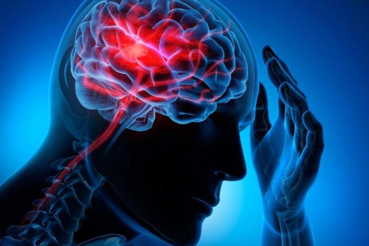 AVC em mulheres jovens é mais frequente do que em homens