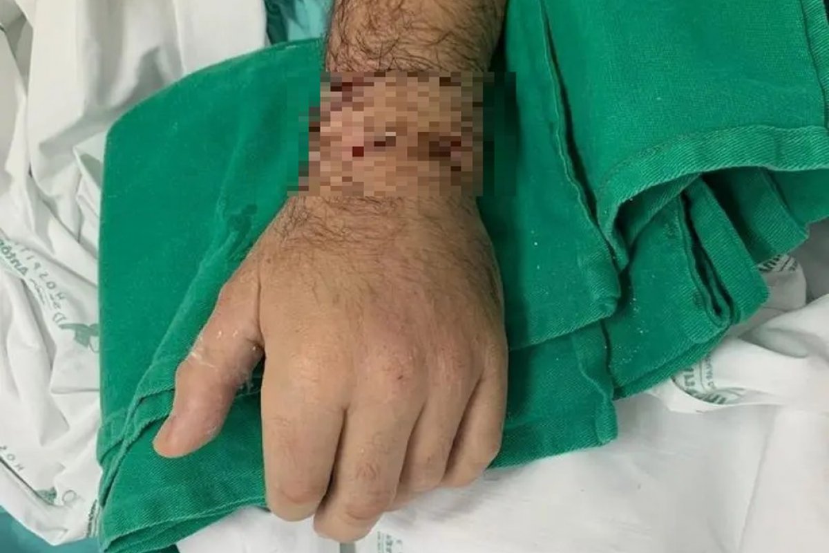 Homem tem mão reimplantada após ser amputado com facão durante briga em Santa Catarina
