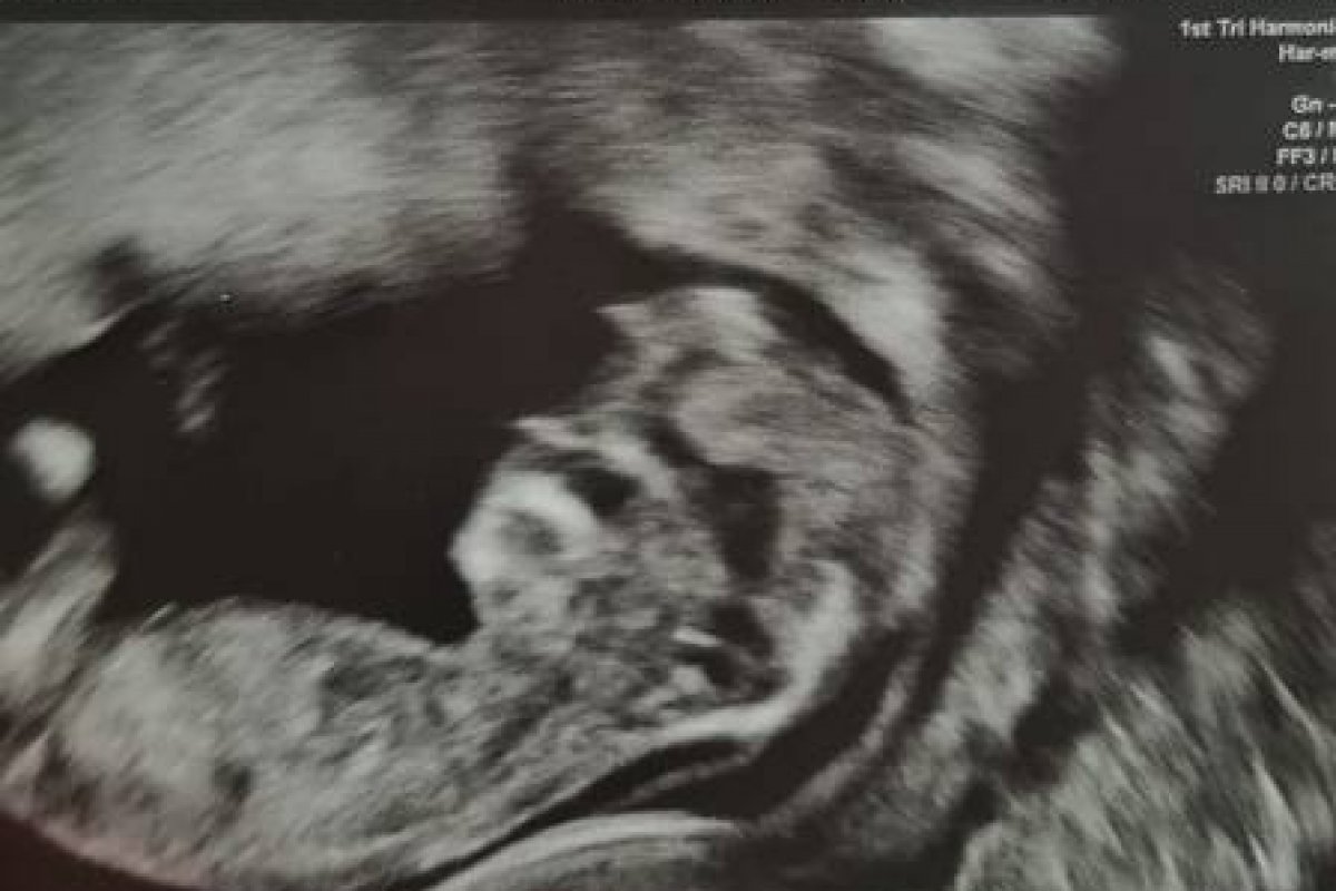 Grávida se choca ao ver bebê com 'rosto de Trump' durante ultrassom
