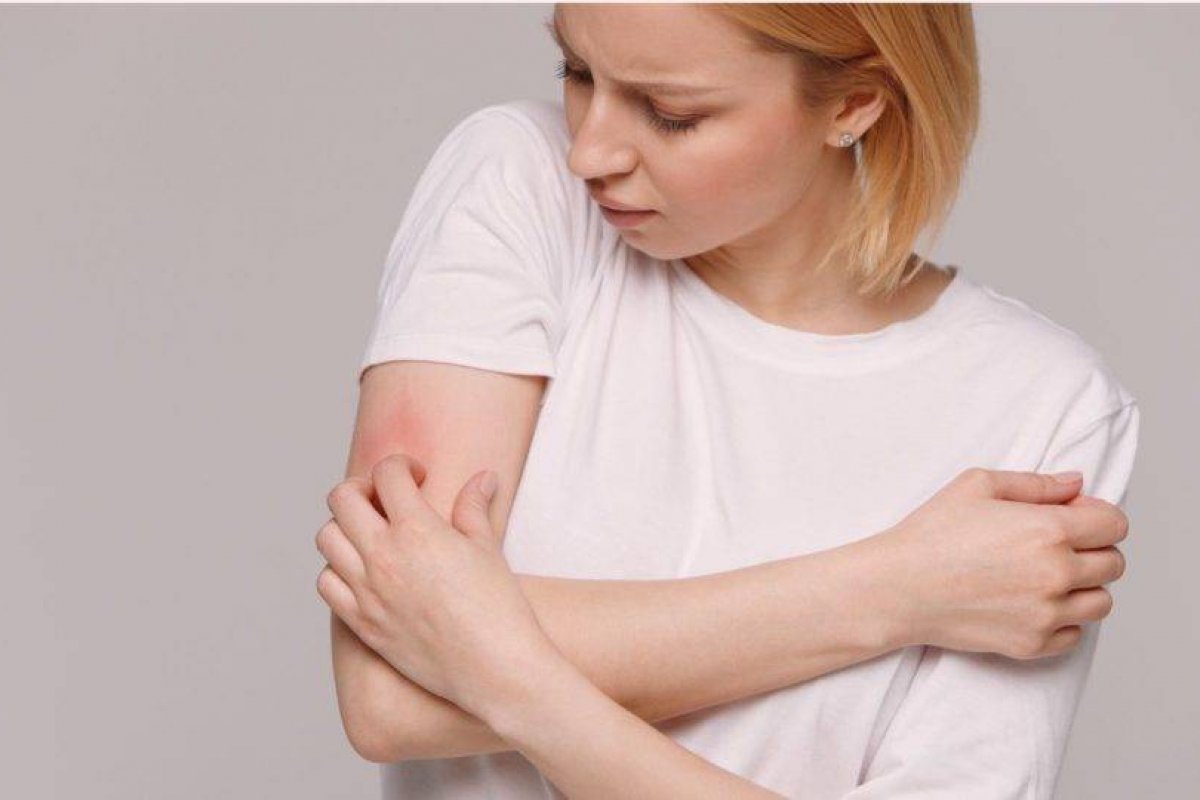 Pacientes com Covid-19 prolongada podem ter problemas de pele, diz estudo