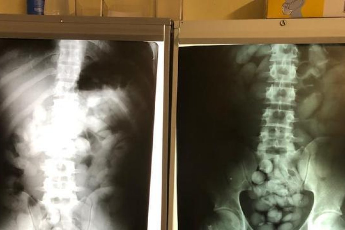 Homem é preso com cápsulas de cocaína no estômago