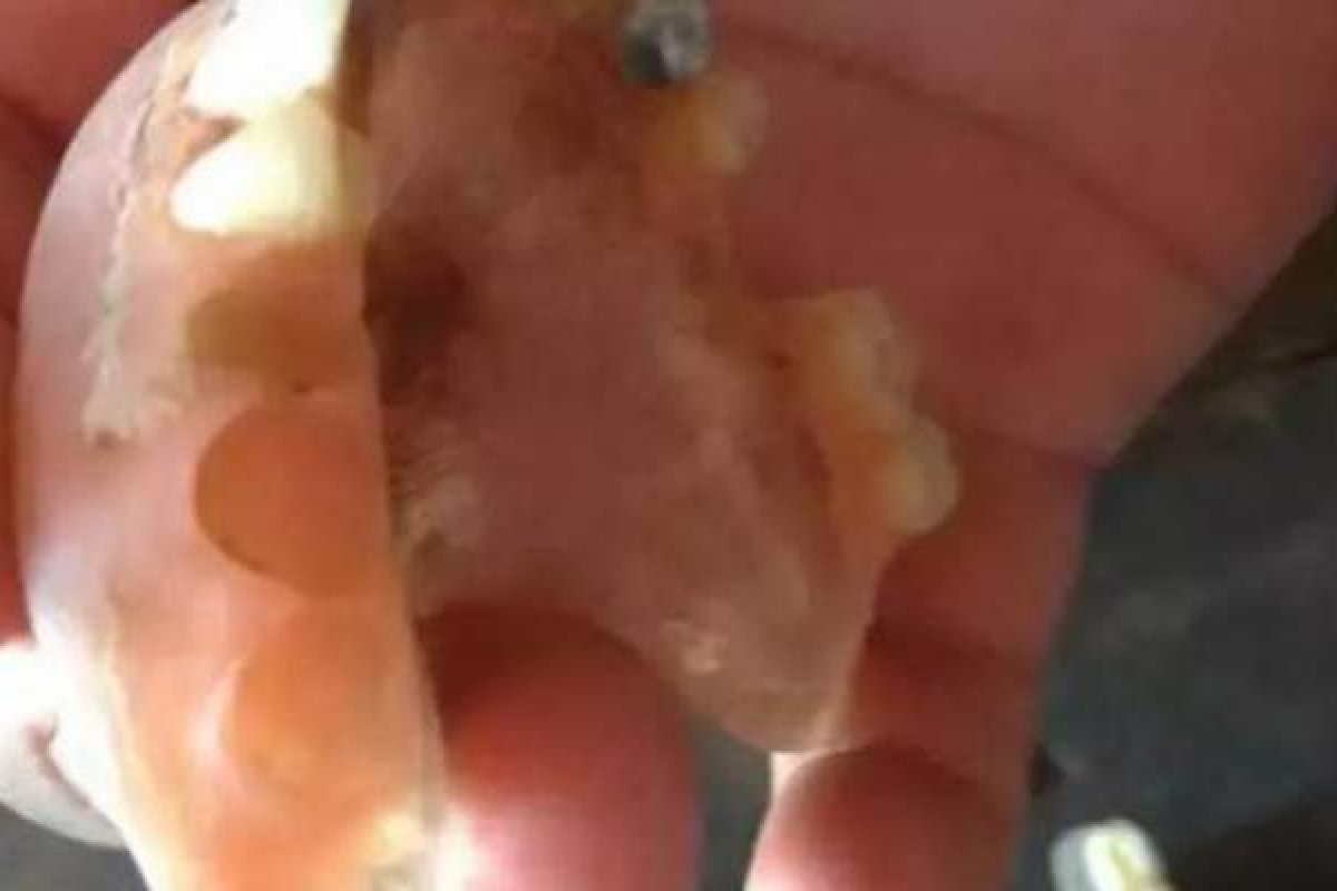 Idoso morto por causa da covid-19 tem dentes de ouro roubados em hospital