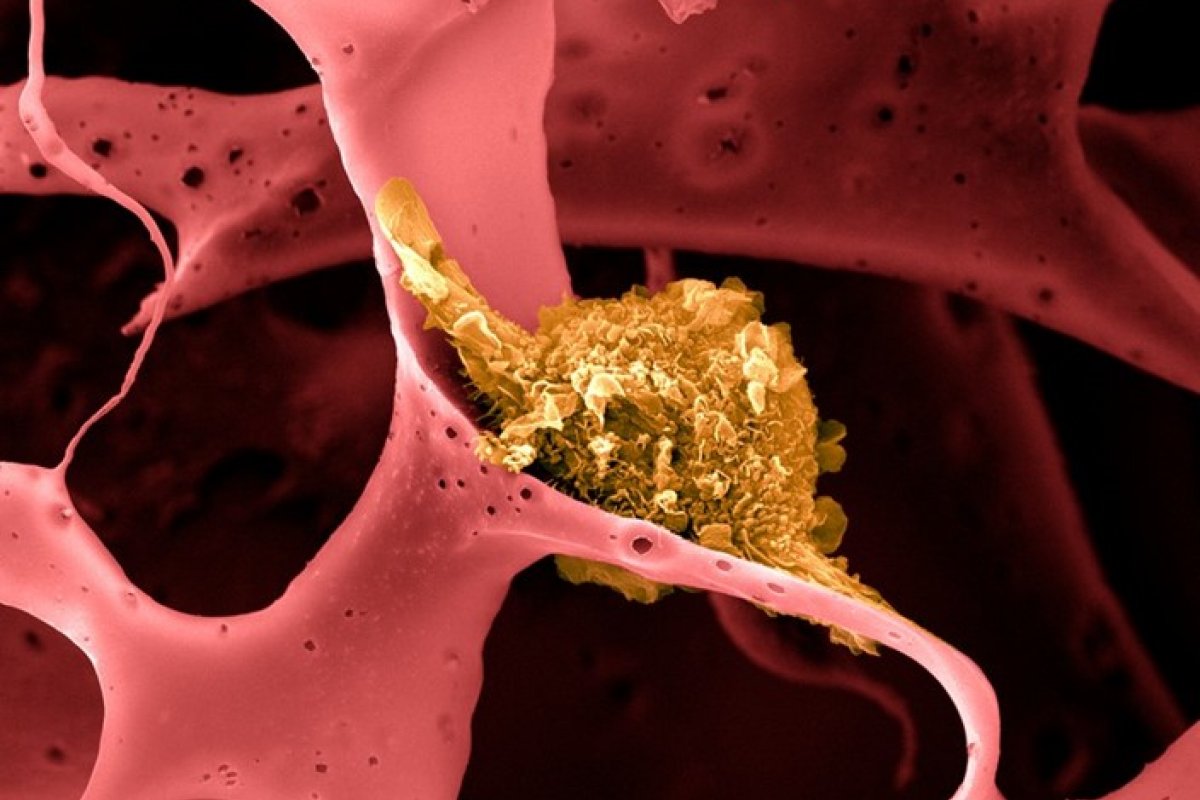 Vacina que previne câncer de mama é 100% eficaz em camundongos 