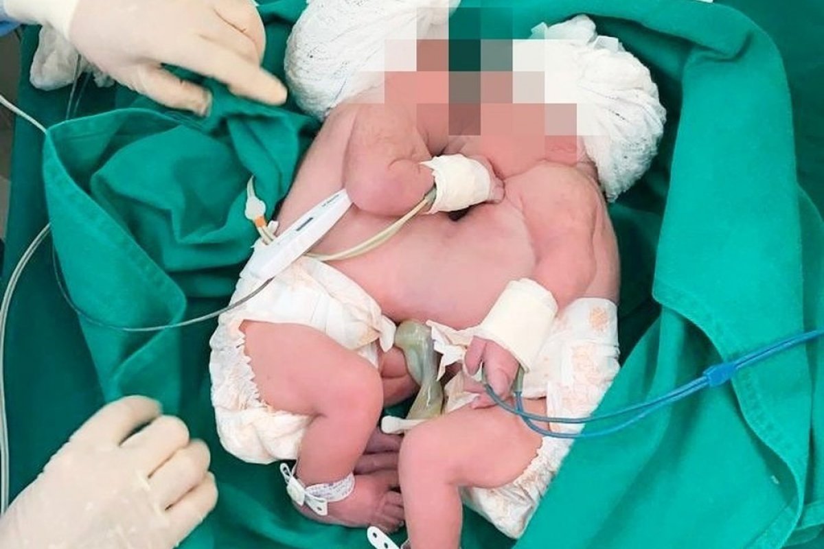 Gêmea siamesa separada por cirurgia é desentubada