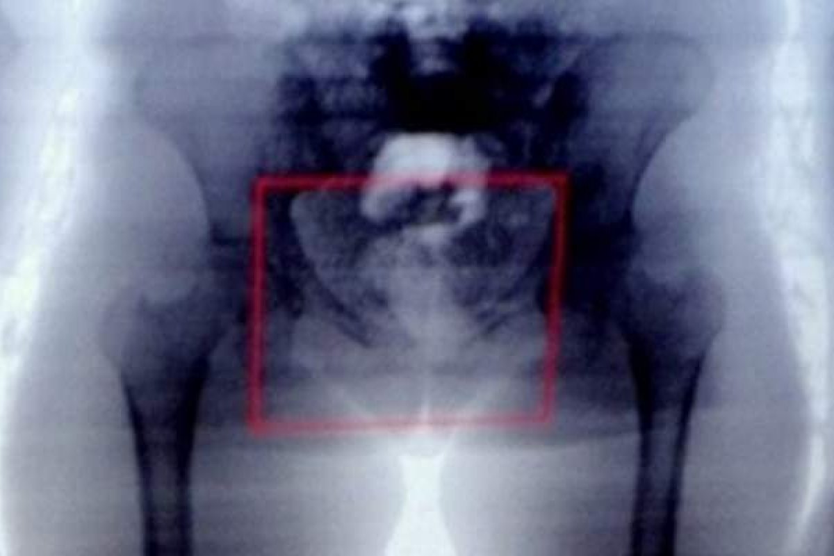 Mulheres são presas ao tentarem entrar em presídio com drogas nas partes íntimas 