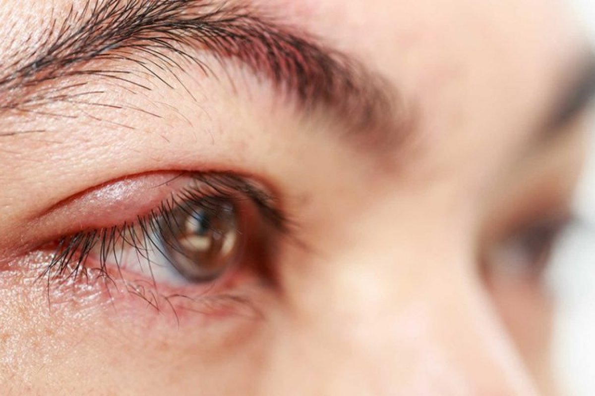 Uso indiscriminado de testosterona pode agravar blefarite