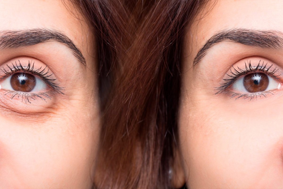 Olheiras: para cada tipo, um tratamento diferente