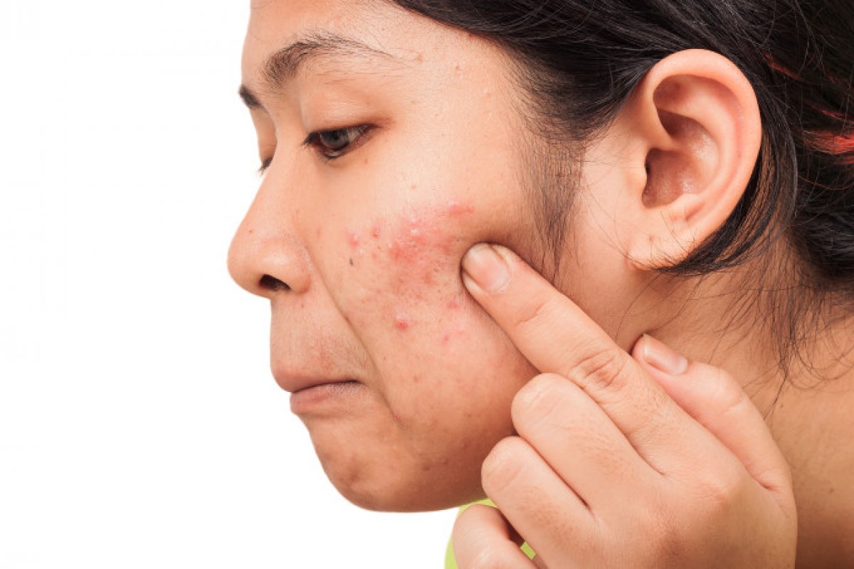 Mais de 50% dos brasileiros sofrem com a acne