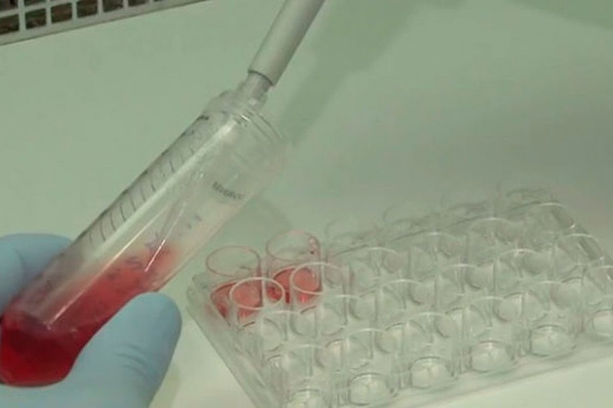 Cresce para 30 o número de casos da doença que deixa 'urina preta' na Bahia