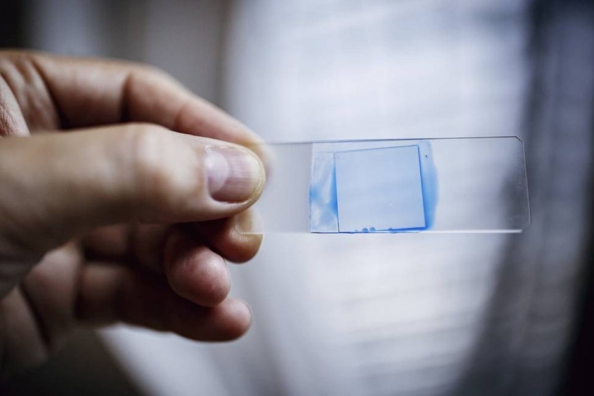 Superfungo identificado na Bahia mata 39% dos contaminados, aponta pesquisa