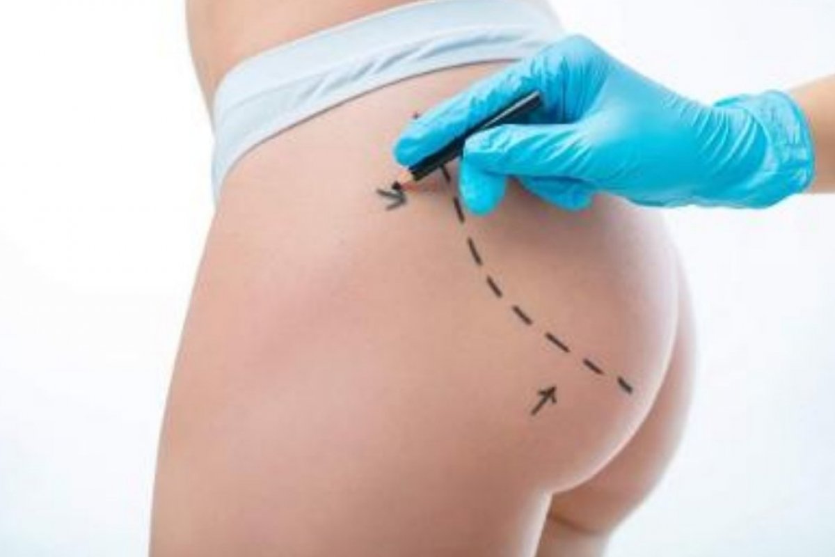 Procedimento levanta bumbum: bioestimulador de colágeno para efeito lifting e maior firmeza na área