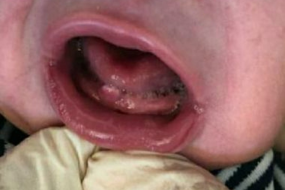 Bebê nasce com dente e surpreende funcionários de maternidade em Itororó