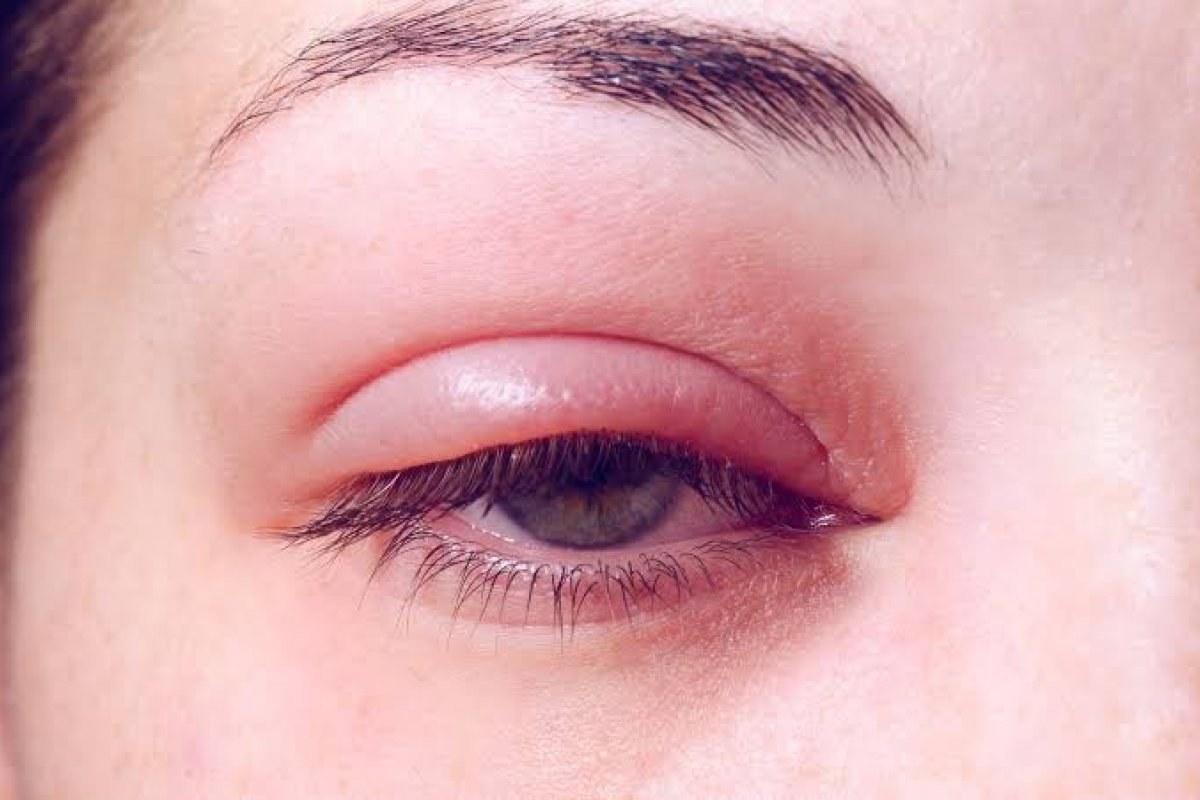 9 perguntas e respostas sobre o terçol